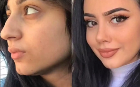 Best Rhinoplasty Surgeon in Dubai for Wide Nose Correction