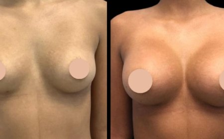 From Consultation to Transformation: Breast Augmentation in Dubai