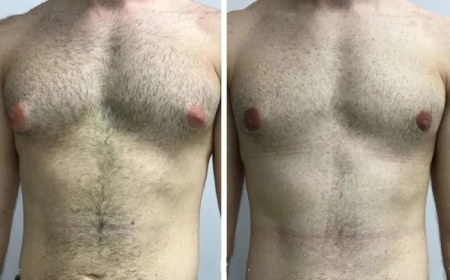 How Long Do the Results of Gynecomastia Surgery in Dubai Last?