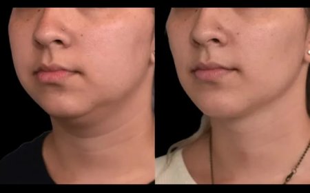 How Long is the Downtime After Double Chin Removal Surgery in Dubai?