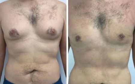 What Are the Key Indicators That You Need Gynecomastia Surgery in Dubai?