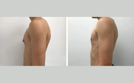 What Makes a Gynecomastia Surgery in Dubai Successful with the Best Surgeon?