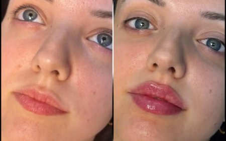 Understanding Fillers Treatment in Dubai for Skin Rejuvenation