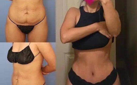 Tummy Tuck in Dubai: Exploring the Procedure Step by Step