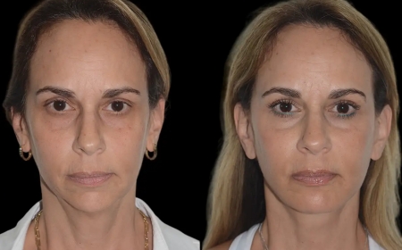 How to Find the Best Doctors in Dubai for Safe and Effective Chin Fillers