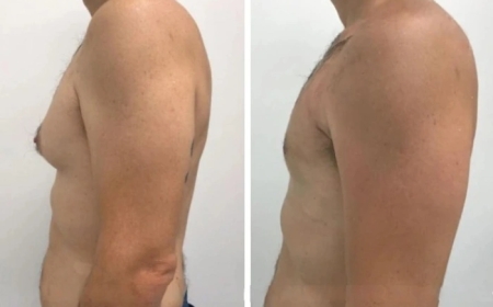 What to Know About Gynecomastia Recovery in Dubai