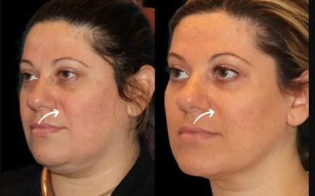 How to Find Discounted or Promotional Offers for Sculptra Fillers in Dubai
