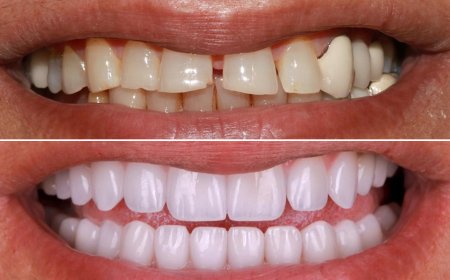 Veneers Dubai: Achieve a Hollywood Smile in the Heart of the UAE
